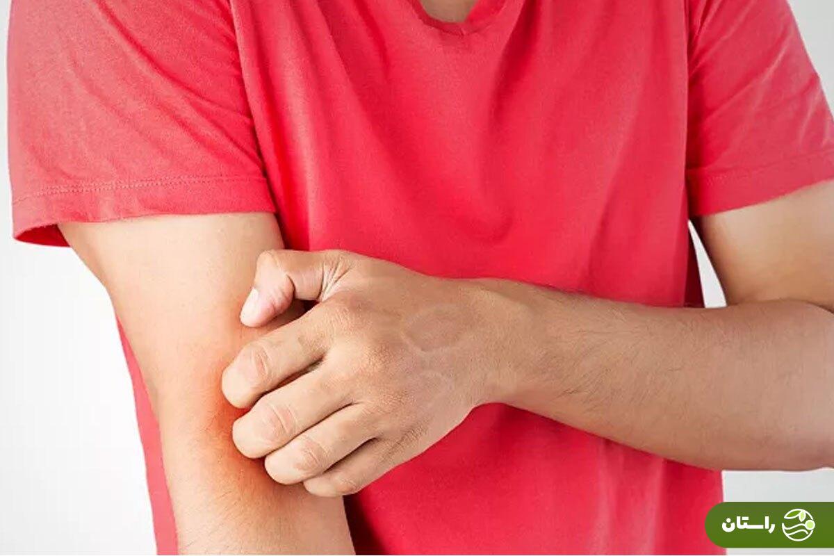 پاسخ دانشمندان به یک سوال قدیمی؛ آیا باید محل خارش را خاراند؟ پاسخ دانشمندان به یک سوال قدیمی؛ آیا باید محل خارش را خاراند؟