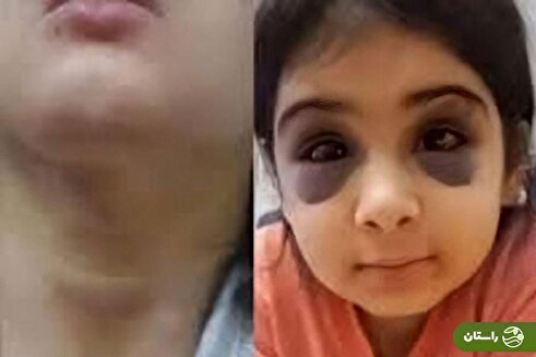  تصاویر دلخراش از شکنجه آنیلا ساعدی، دختربچه ۹ ساله سنندجی توسط نامادری