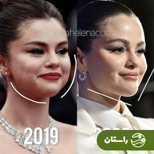 تصاویر  وایرال شده از قبل و بعد از جراحی سلنا گومز