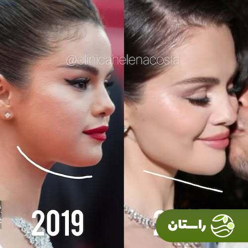تصاویر  وایرال شده از قبل و بعد از جراحی سلنا گومز