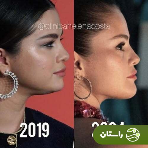 تصاویر  وایرال شده از قبل و بعد از جراحی سلنا گومز