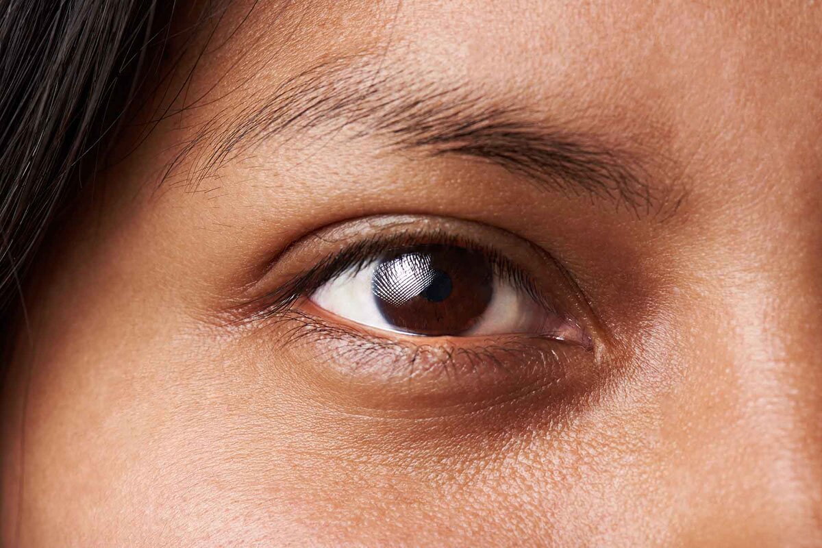 سیاهی دور چشم؛ علت‌ها و راه‌های درمان آن