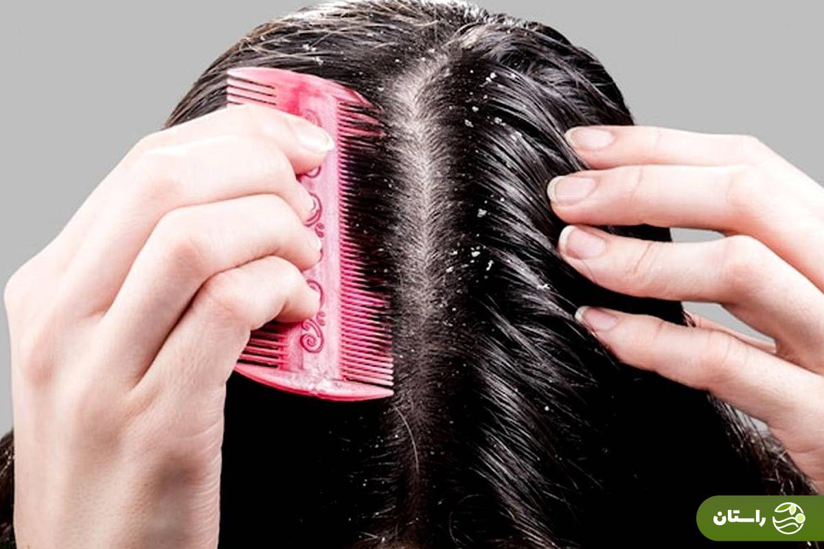 راههای درمان شوره سر چرب خانگی راههای درمان شوره سر چرب خانگی