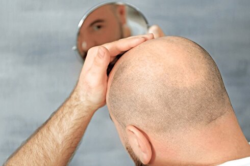 علت طاسی سر چیست؟ آیا راهی برای پیشگیری از طاسی وجود دارد؟