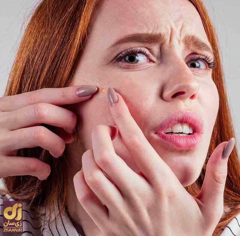 چطور جای جوش را از بین ببریم؟