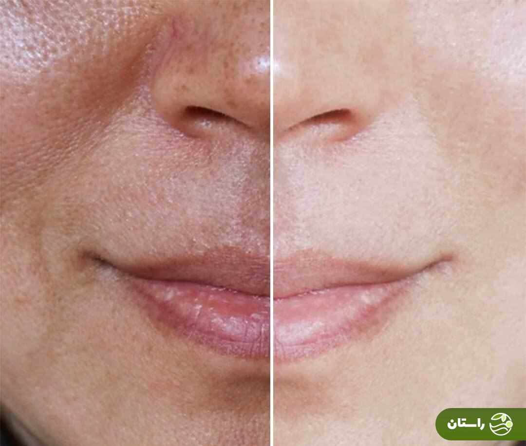 راهو روشهای ساده بستن منافذ پوست را برای داشتن یک صورت زیبا یاد بگیرید راهو روشهای ساده بستن منافذ پوست را برای داشتن یک صورت زیبا یاد بگیرید