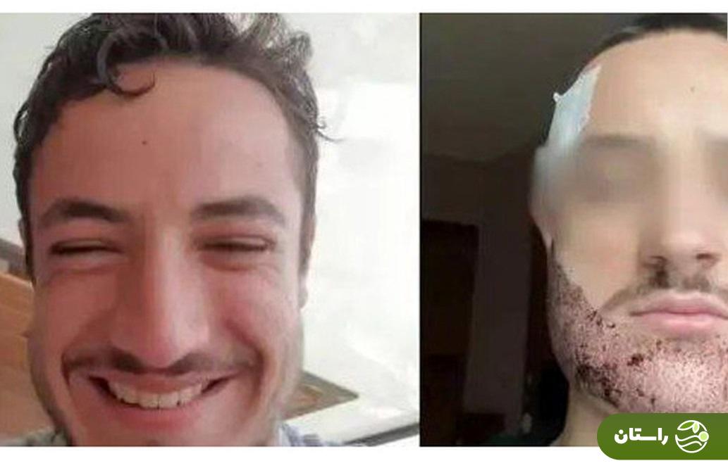 عکس |‌ خودکشی بخاطر بد شدن کاشت ریش!
