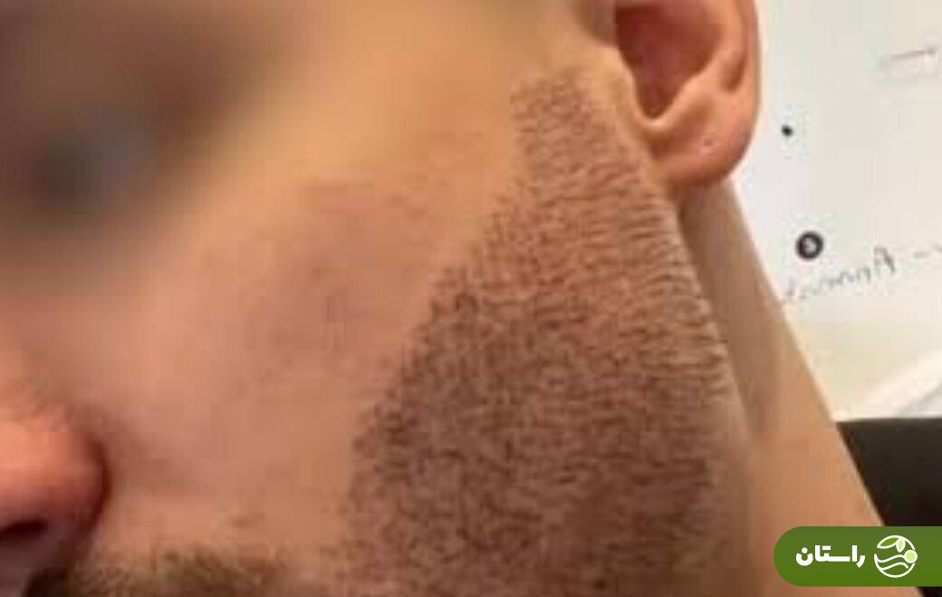 عکس |‌ خودکشی بخاطر بد شدن کاشت ریش!