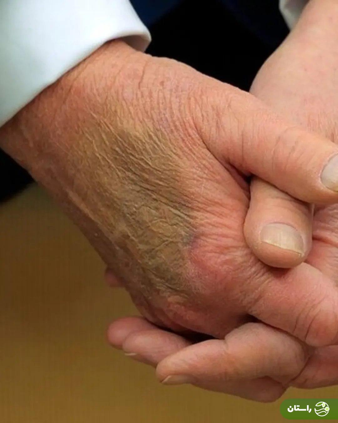 علت ورم دست و پای دونالد ترامپ مشخص شد؛ بیماری رئیس جمهور آمریکا چیست؟ علت ورم دست و پای دونالد ترامپ مشخص شد؛ بیماری رئیس جمهور آمریکا چیست؟