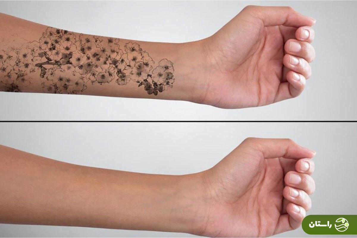 از تتو پیشمان شدی؟! با این روش جادویی در خانه تتو و خالکوبی را پاک کن + همه چیز درباره پاک کردن تتو از تتو پیشمان شدی؟! با این روش جادویی در خانه تتو و خالکوبی را پاک کن + همه چیز درباره پاک کردن تتو