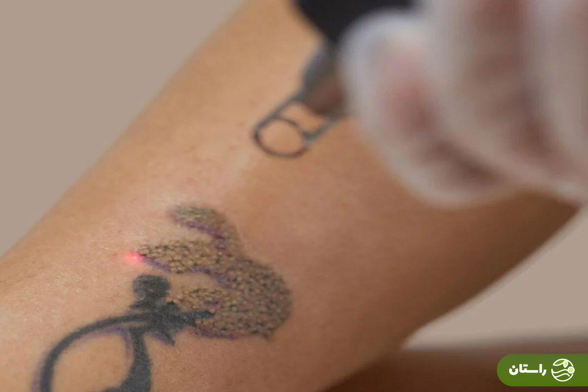 از تتو پیشمان شدی؟! با این روش جادویی در خانه تتو و خالکوبی را پاک کن + همه چیز درباره پاک کردن تتو از تتو پیشمان شدی؟! با این روش جادویی در خانه تتو و خالکوبی را پاک کن + همه چیز درباره پاک کردن تتو