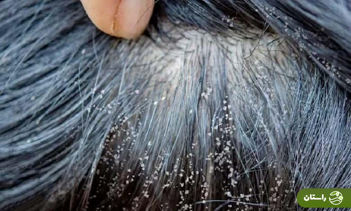 روش درمان شپش سر با پودر ماشین لباسشویی + عوارض و نکات مهم