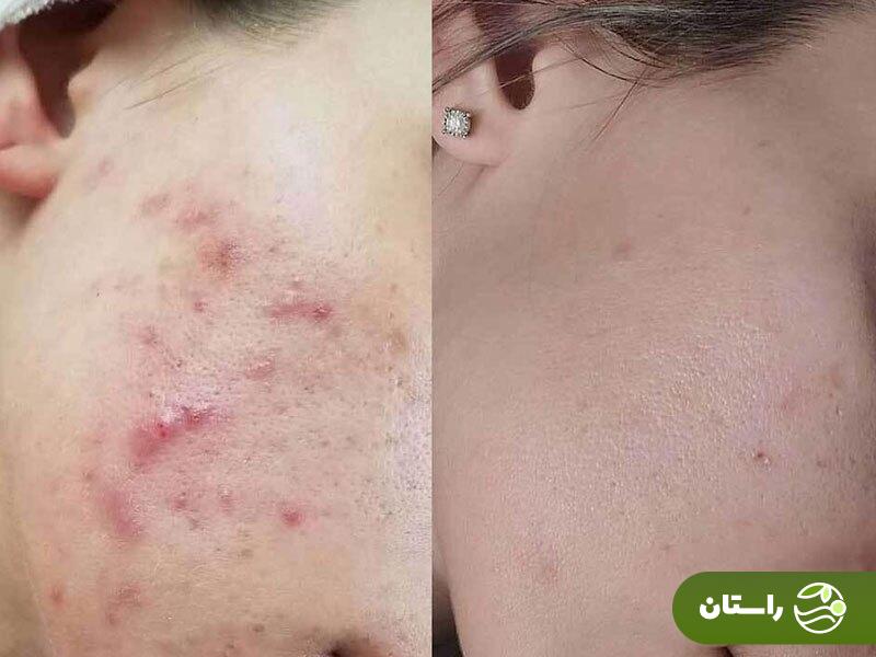 اسکراب صورت چیست و چرا برای پوستتان واجب است؟ + ۵ اسکراب خانگی فوقالعاده اسکراب صورت چیست و چرا برای پوستتان واجب است؟ + ۵ اسکراب خانگی فوقالعاده