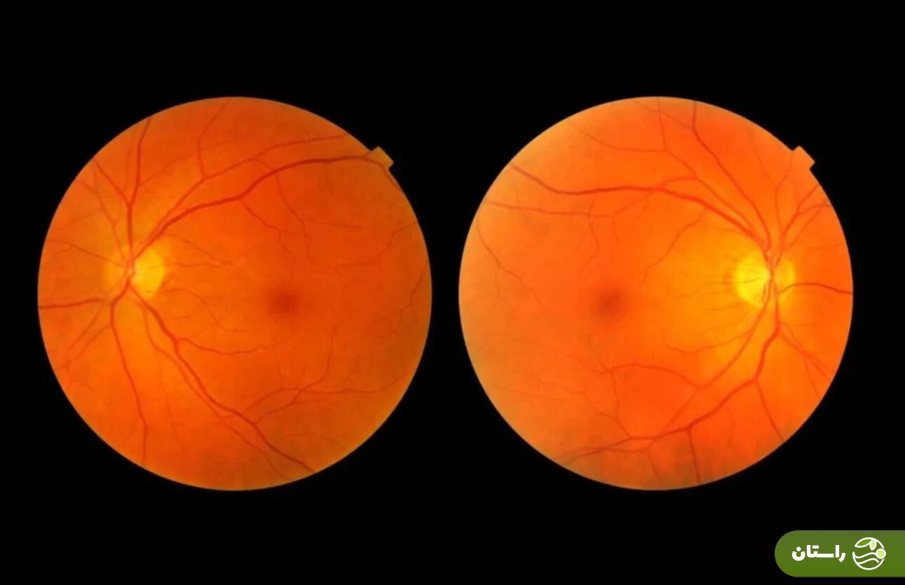 اگر بدنی زیبا و لاغر میخواهید مراقب بینایی خود باشید اگر بدنی زیبا و لاغر میخواهید مراقب بینایی خود باشید