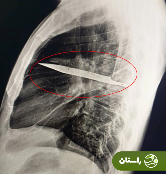 مردی ۸ سال با تیغه چاقو در قفسه سینهاش زندگی کرد بدون آنکه بداند! مردی ۸ سال با تیغه چاقو در قفسه سینهاش زندگی کرد بدون آنکه بداند!