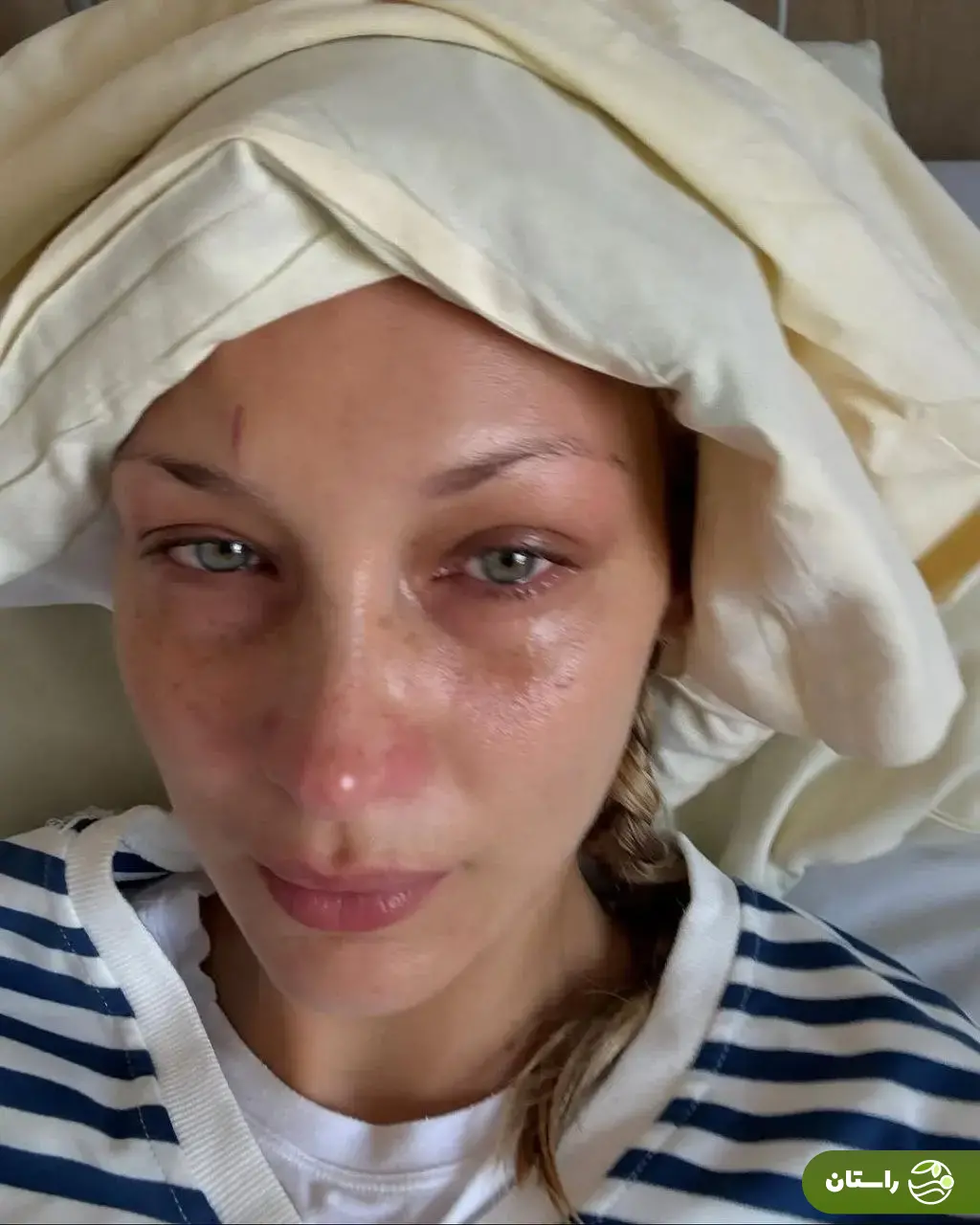 تصاویر شوکه‌کننده از مدل مشهور آمریکایی؛ بیماری بلا حدید چیست؟