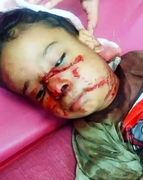 تصویر +18 | عکس دلخراش از حمله سگ به کودک خوزستانی تصویر +18 | عکس دلخراش از حمله سگ به کودک خوزستانی