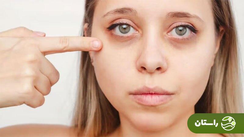 کمبود کدام ویتامین باعث پف زیر چشم میشود؟
