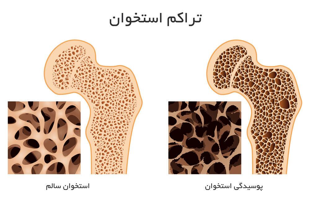 برای افزایش تراکم استخوان چه بخوریم؟ برای افزایش تراکم استخوان چه بخوریم؟