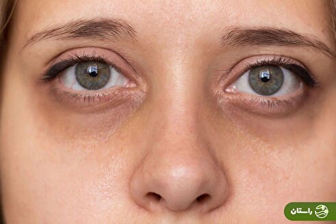 کمبود کدام ویتامین باعث پف زیر چشم میشود؟