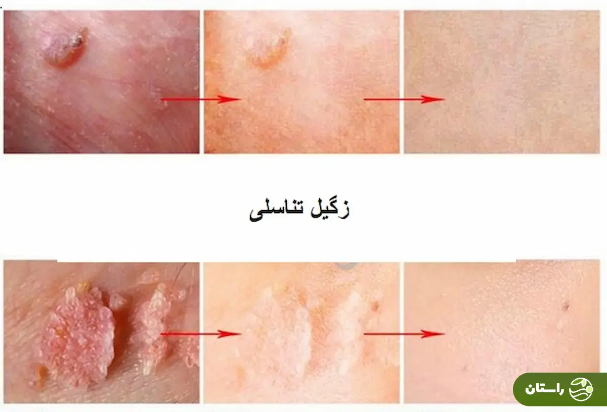 واکسن گارداسیل چیست و بهترین زمان تزریق آن چه وقت است؟ واکسن گارداسیل چیست و بهترین زمان تزریق آن چه وقت است؟