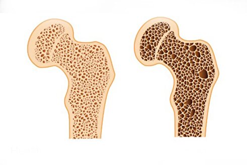 برای افزایش تراکم استخوان چه بخوریم؟ / نمونه برنامه غذایی روزانه مبتلایان به استئوپنی/ ورزش‌های مناسب تراکم استخوان 