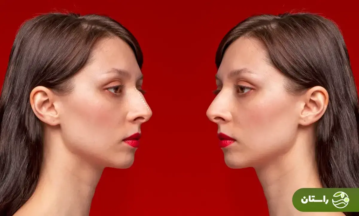 فیلمی از رونمایی از اولین جراحی «بینی قوزدار»  ترند زیبایی سال ۲۰۲۶  در ایران!