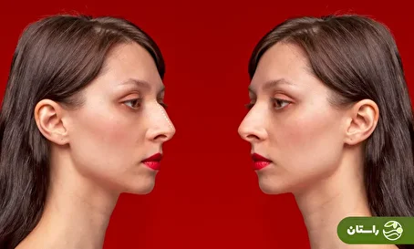 فیلمی از رونمایی از اولین جراحی «بینی قوزدار»  ترند زیبایی سال ۲۰۲۶  در ایران!