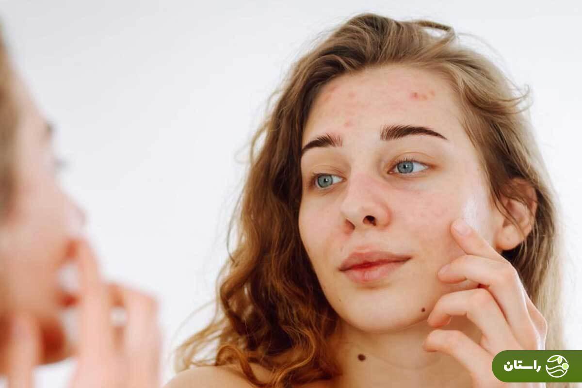 «مثلث مرگ» چیست و چرا فشار دادن جوش روی بینی یا کندن موی بینی می‌تواند ما را به بیمارستان بکشاند؟