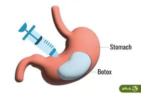 بوتاکس معده چیست و چقدر در کاهش وزن موثر است؟