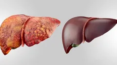 چرا کبد چرب خطرناک است؟ | راه‌های پیشگیری از کبد چرب