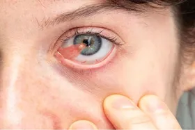 ناخنک چشم چیست و چگونه درمان می‌شود؟