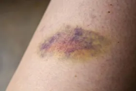 ۵ علت کبودی پوست