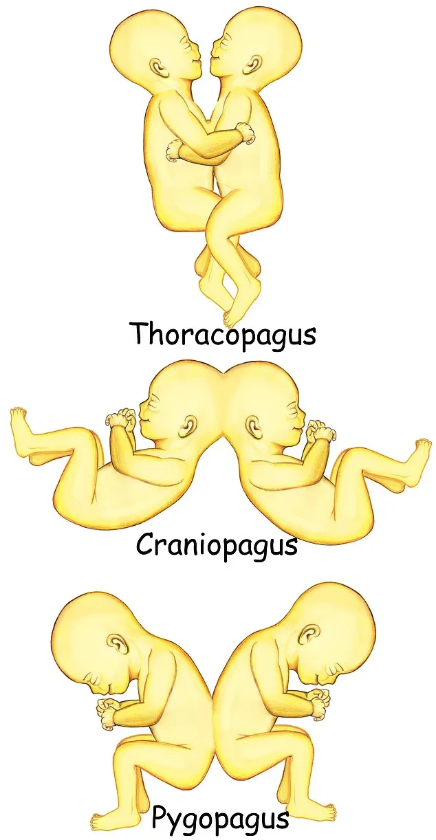 دوقلوهای به هم چسبیده