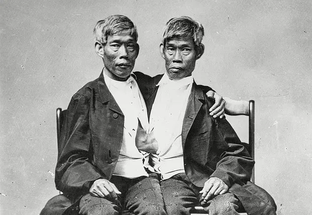 دوقلوهای به هم چسبیده