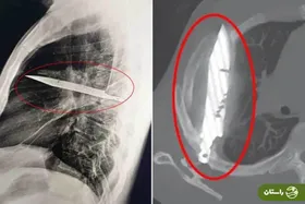 مردی ۸ سال با تیغه چاقو در قفسه سینه‌اش زندگی کرد بدون آن‌که بداند!