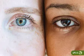  جراحی تغییر رنگ چشم؛ داشتن چشمان رنگی به قیمت کوری!