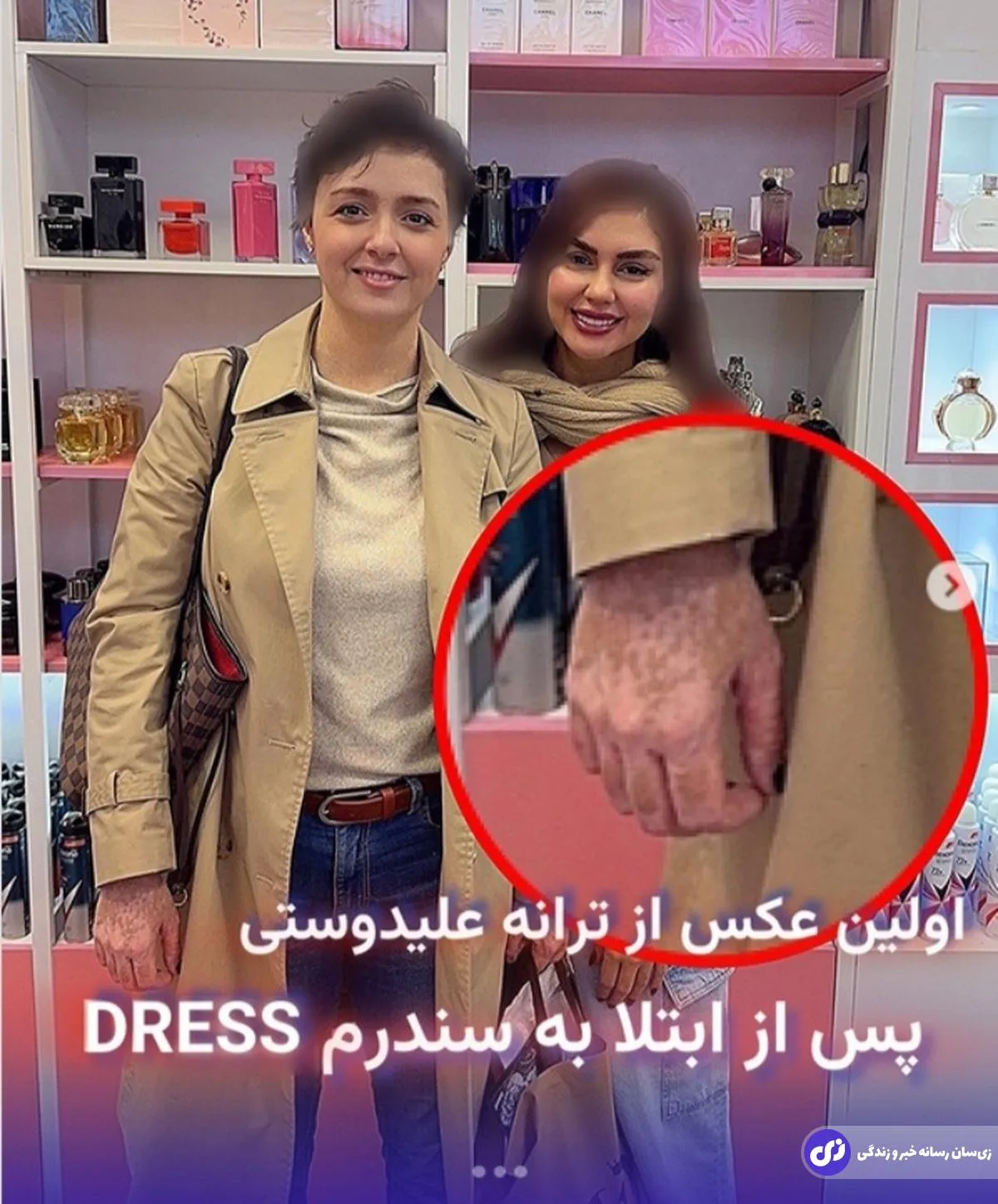 بیماری ترانه عیلدوستی و علائم آن روی دستش