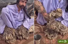 ویدئو | ماجرای زندگی عجیب و دردناک «مرد درختی» ایران + جزییاتی درباره بیماری نادر «اپیدرمودیسپلازی ورموسیفورم»