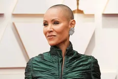 آلوپسی چیست؟ چرا بعضی‌ها از سن پایین ریزش مو دارند؟