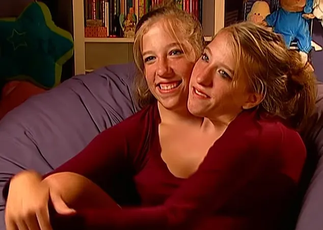 دوقلوهای به هم چسبیده