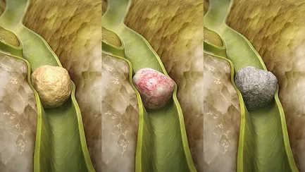 سنگ کیسه صفرا چطور ایجاد می‌شود و چرا زنان در معرض خطر بیشتری هستند؟