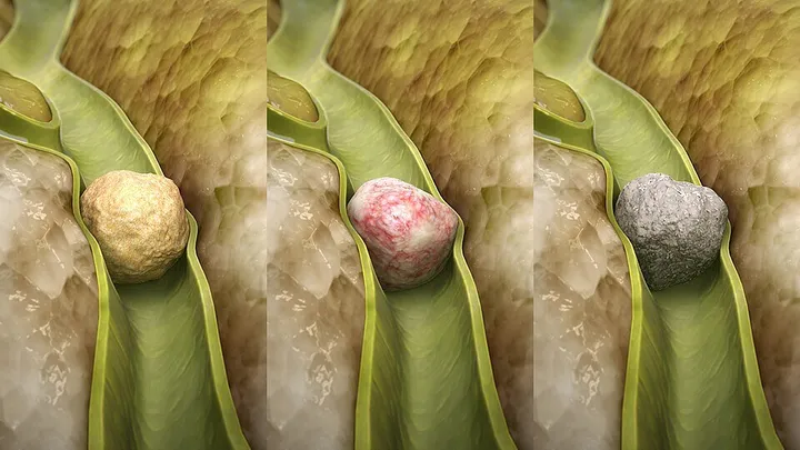 سنگ کیسه صفرا چطور ایجاد می‌شود و چرا زنان در معرض خطر بیشتری هستند؟