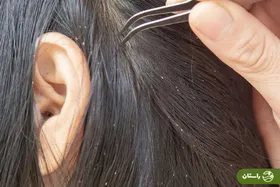 روش درمان شپش سر با پودر ماشین لباسشویی + عوارض و نکات مهم